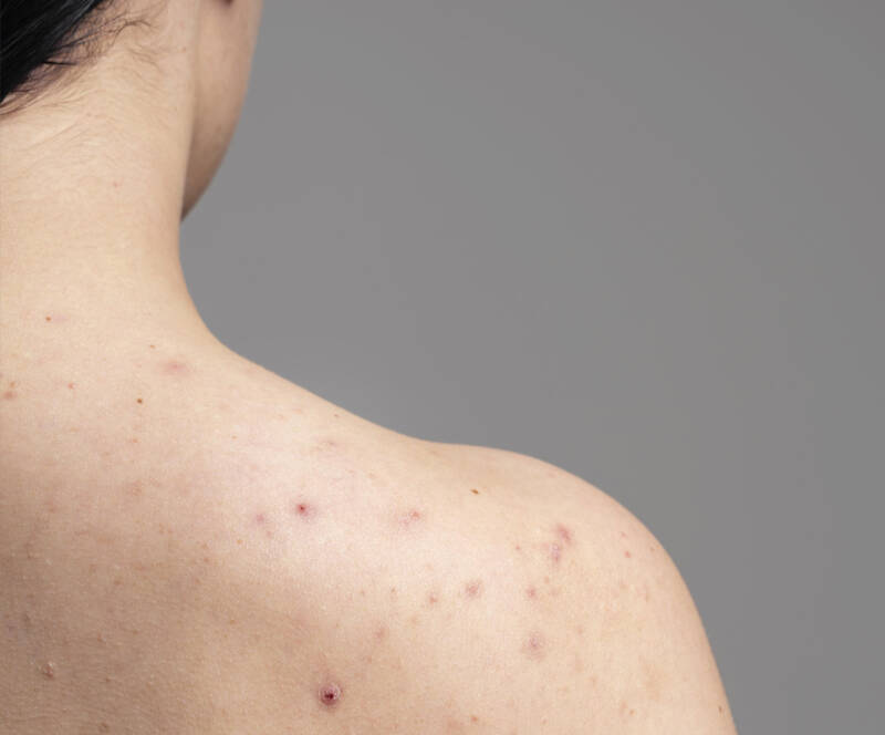 acne sulla schinea come risolverla con AlmaCare?