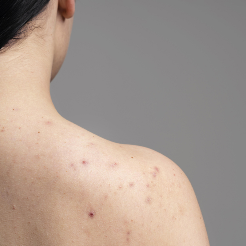 acne sulla schinea come risolverla con AlmaCare?