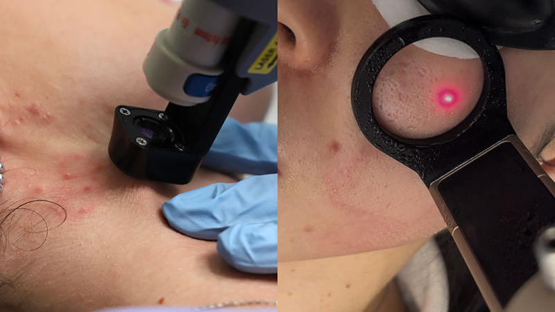 acne attiva rimedi almacare