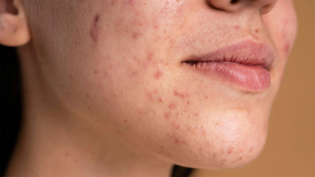 cicatrici acne almacare