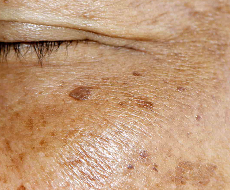 eliminare macchie del viso AlmaCare