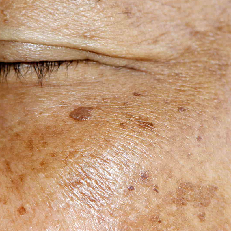 eliminare macchie del viso AlmaCare