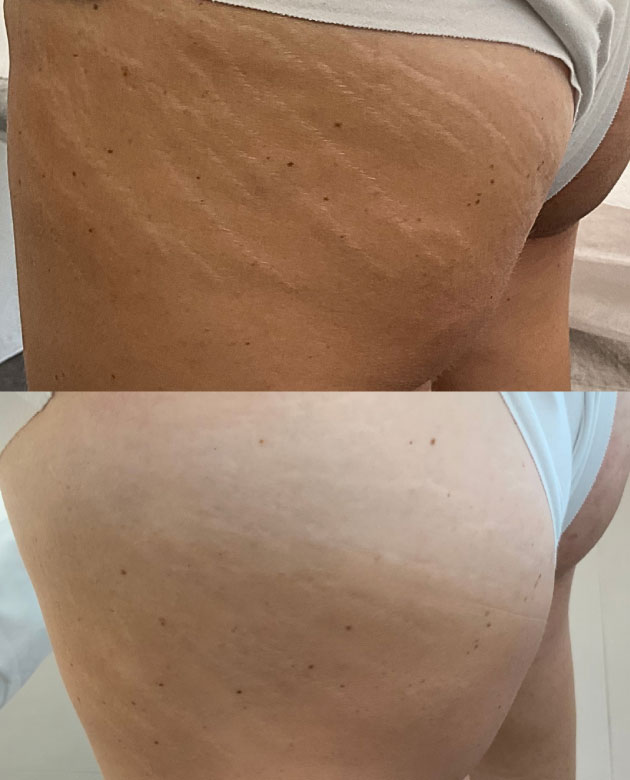 AlmaCare prima e dopo smagliature