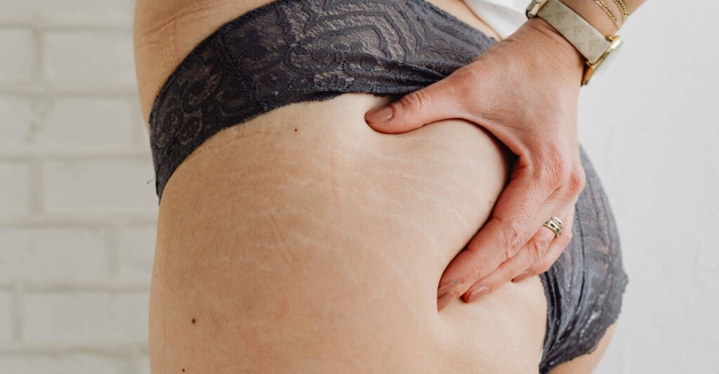 Smagliature rosse o bianche: quale trattamento scegliere?