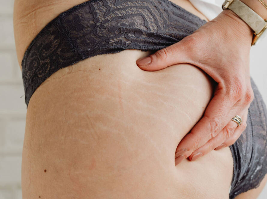 Smagliature rosse o bianche: quale trattamento scegliere?