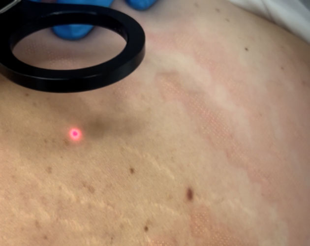 AlmaCare Hybrid smagliature