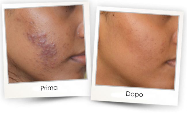 trattamento laser cicatrici acne